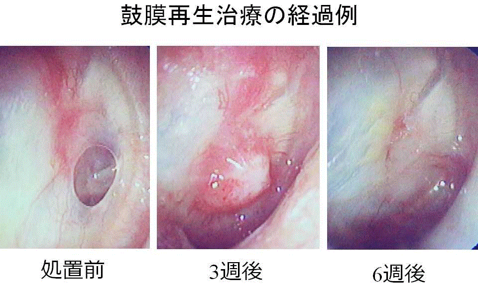 鼓膜再生治療の経過例.gif